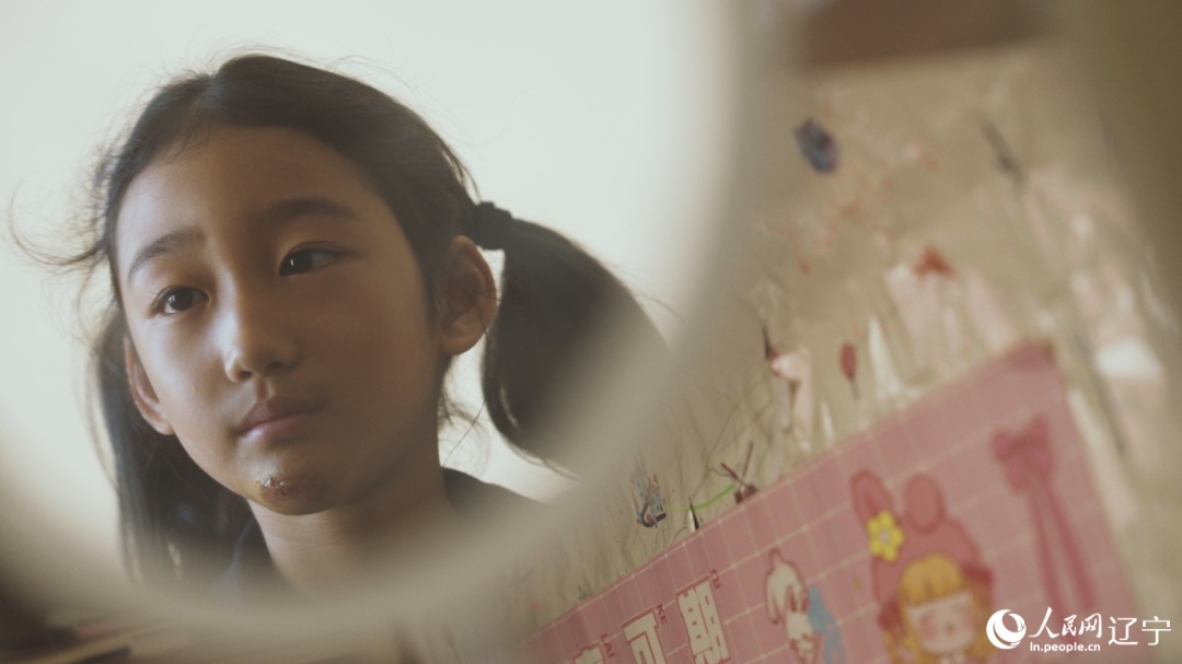 練習(xí)で怪我し、まだあごにかさぶたが殘っている孫暁暁さん。撮影?邱宇哲